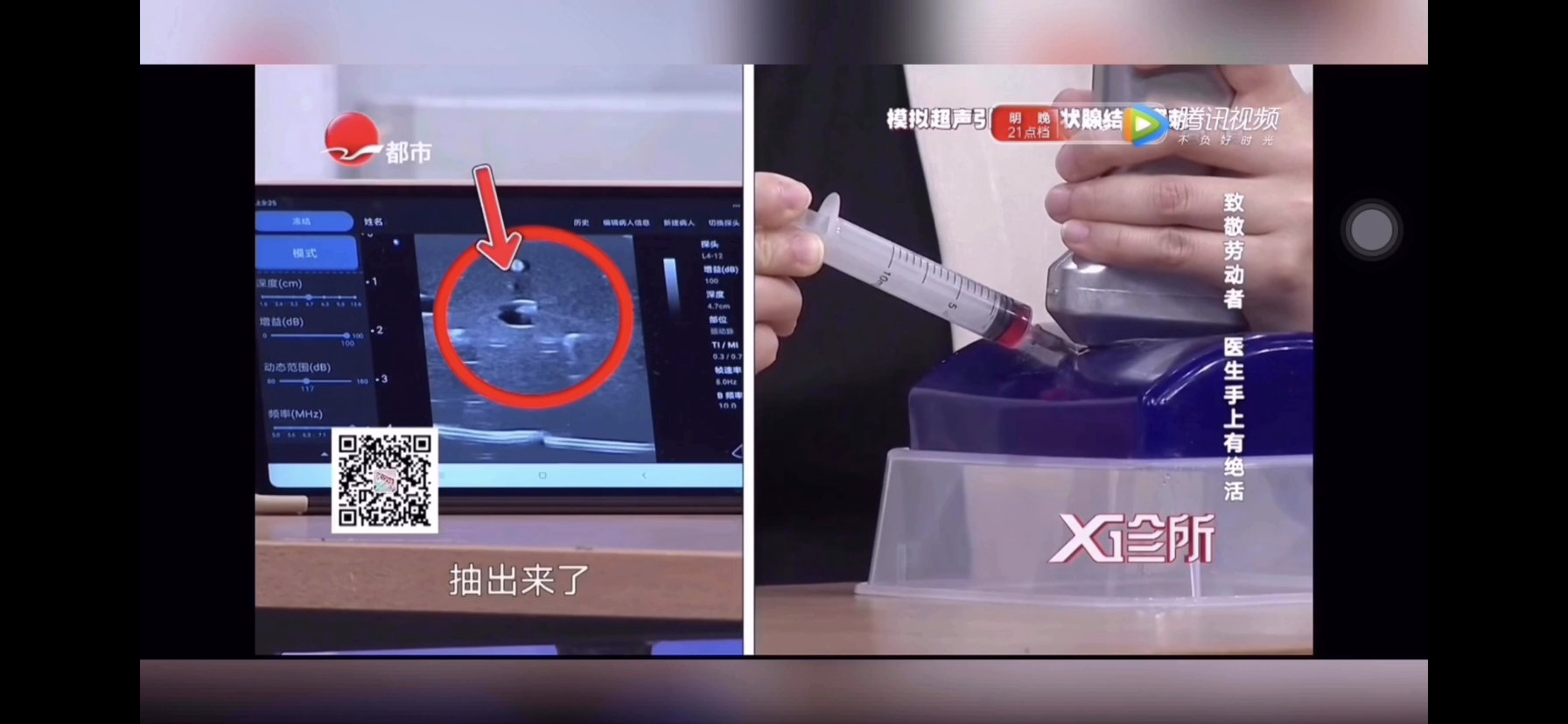 穿刺_副本.jpg